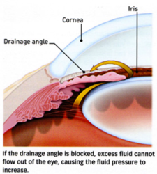 New iStent Procedure by Shofner Vision Center for Glaucoma Patients